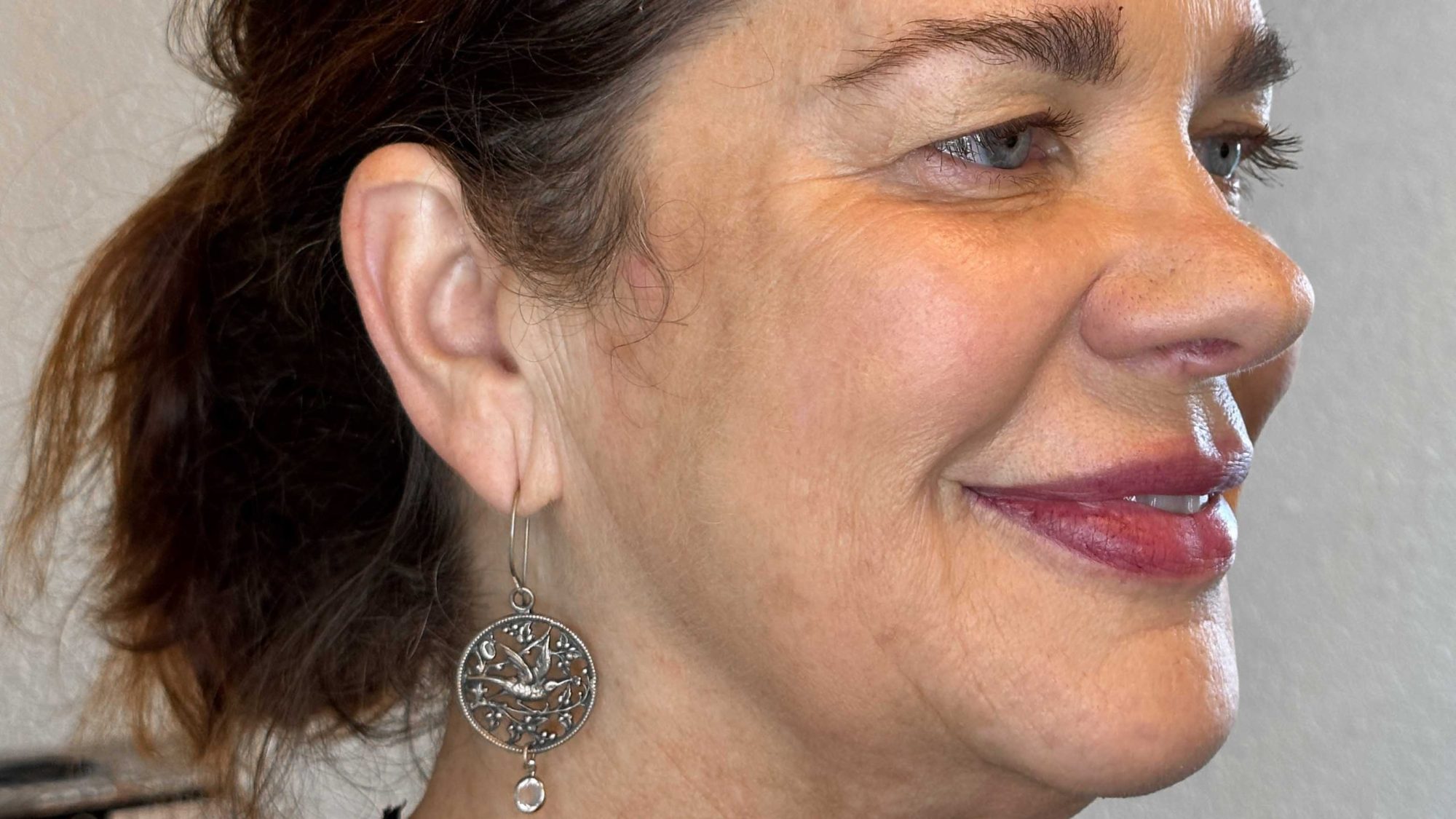 cheek and jowel derma filler juviderm injections west seattle before and after