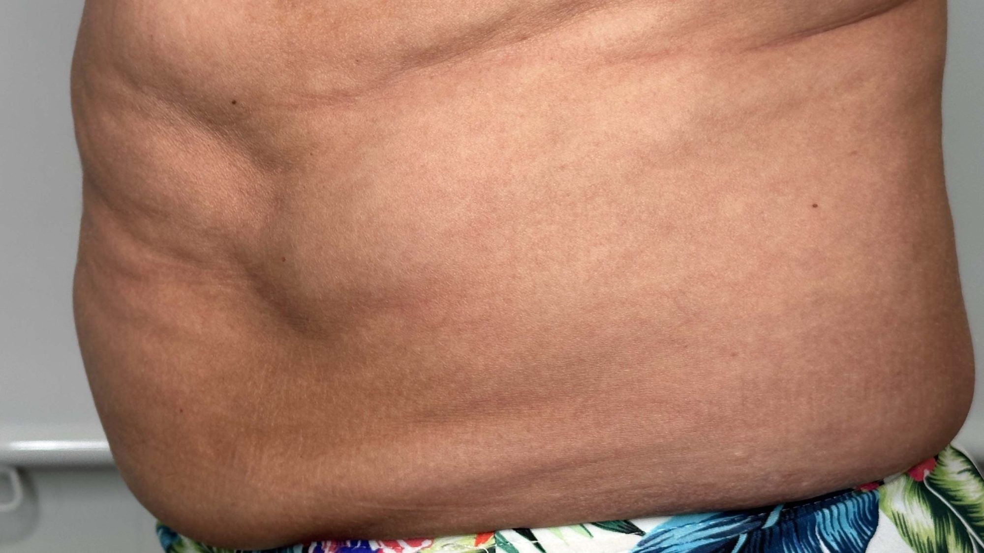 kybella stomach fat removal and flatten tummy west seattle before and after