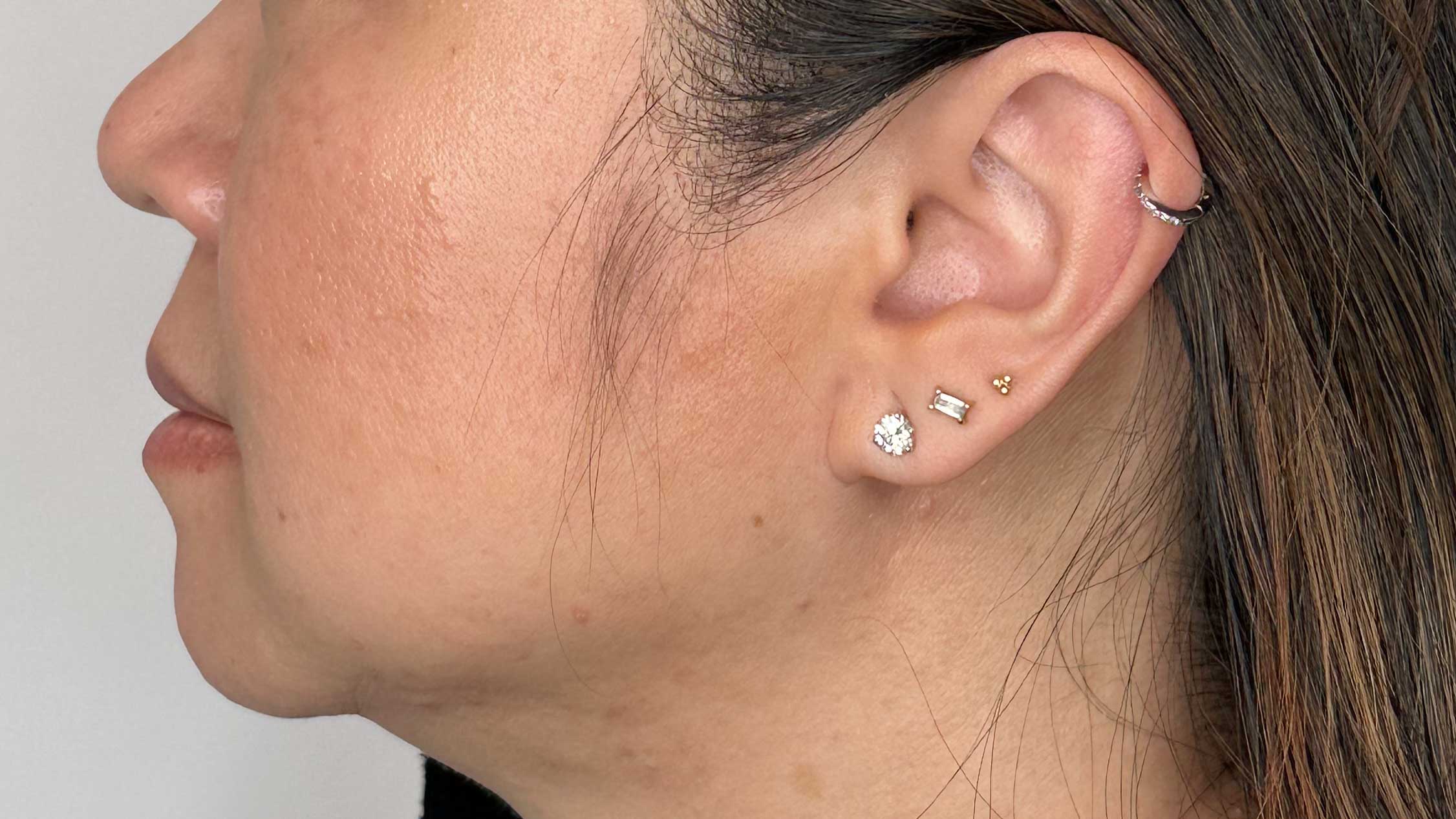 Kybella - Chin - Before -H1 kybella facial fat removal double chin west seattle before and after
