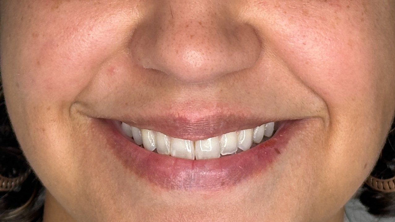 lip flip botox west seattle before and after