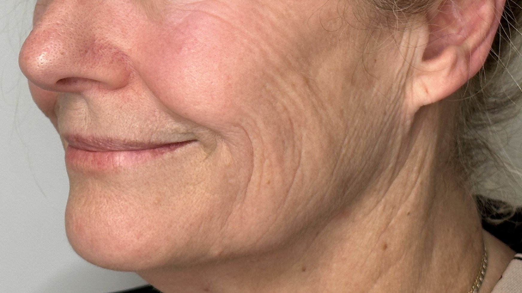 sculptra injection cheek and neck filler lines and wrinkles west seattle before and after
