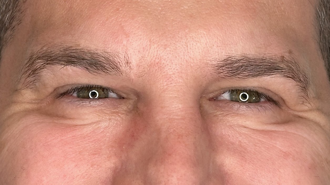 crows feet lines and wrinkles botox west seattle before and after