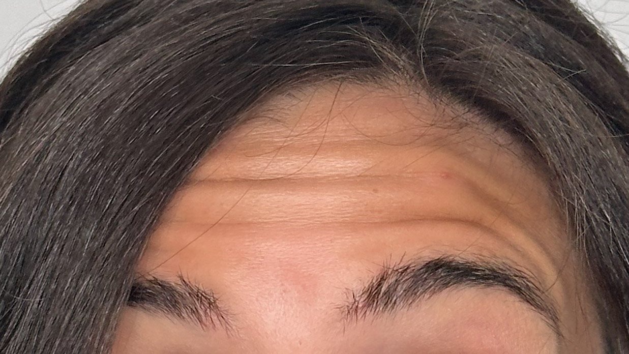 forehead lines and wrinkles botox west seattle before and after