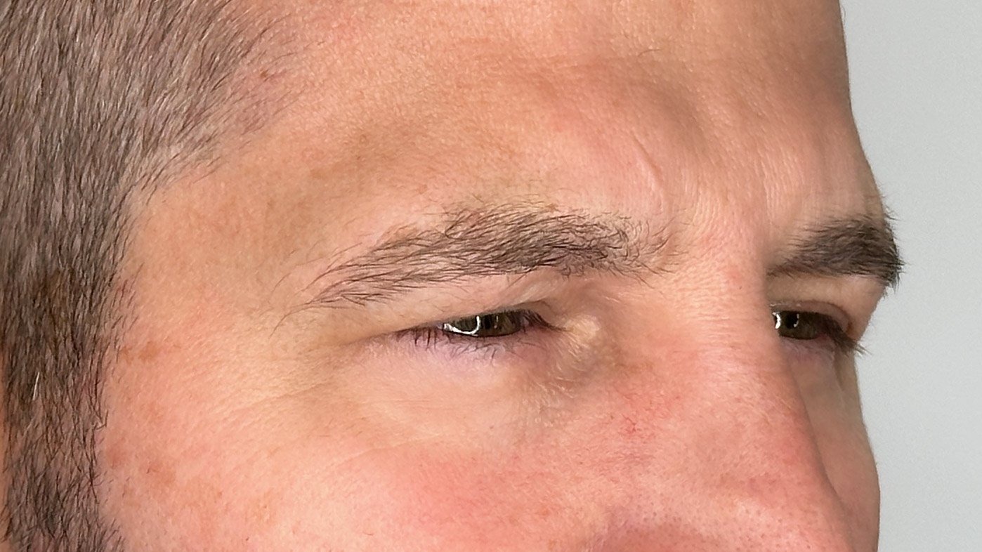 frown lines and wrinkles 11s botox west seattle before and after