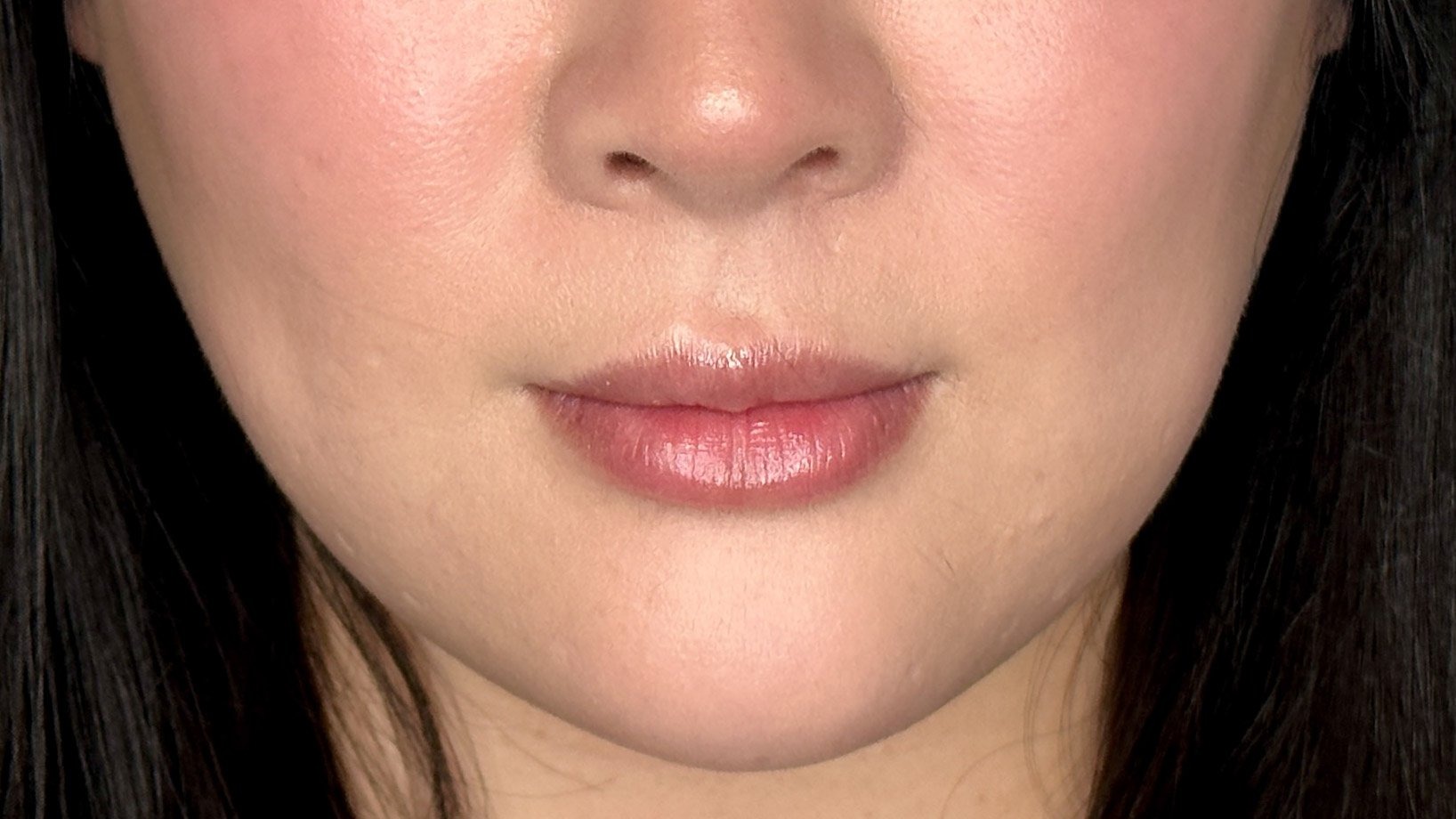 masseter botox west seattle before and after