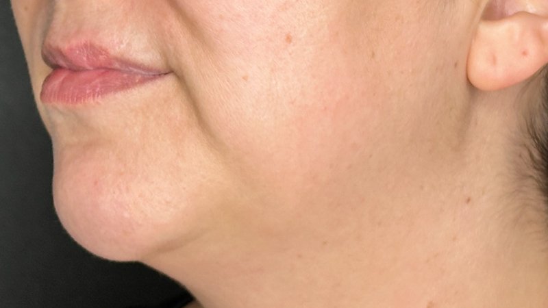 chin and jowel derma filler juviderm injections west seattle before and after