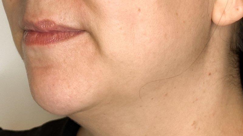 chin and jowel derma filler juviderm injections west seattle before and after