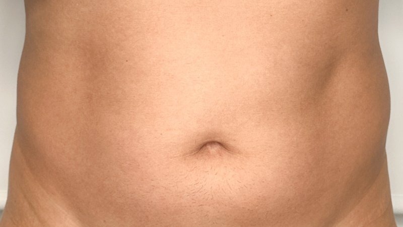 kybella stomach fat removal and flatten tummy west seattle before and after