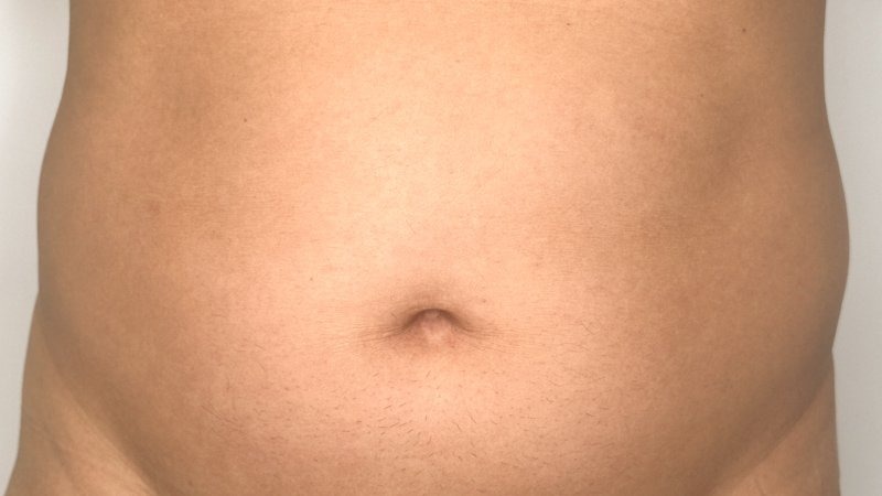 kybella stomach fat removal and flatten tummy west seattle before and after