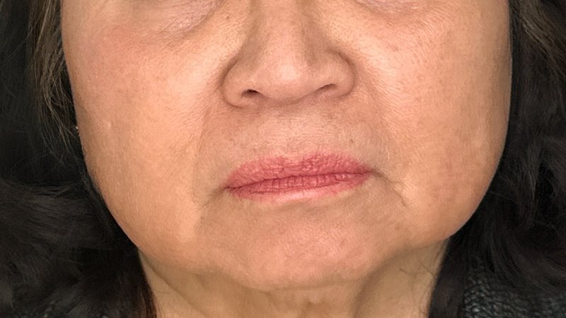 sculptra injection cheek and neck filler lines and wrinkles west seattle before and after