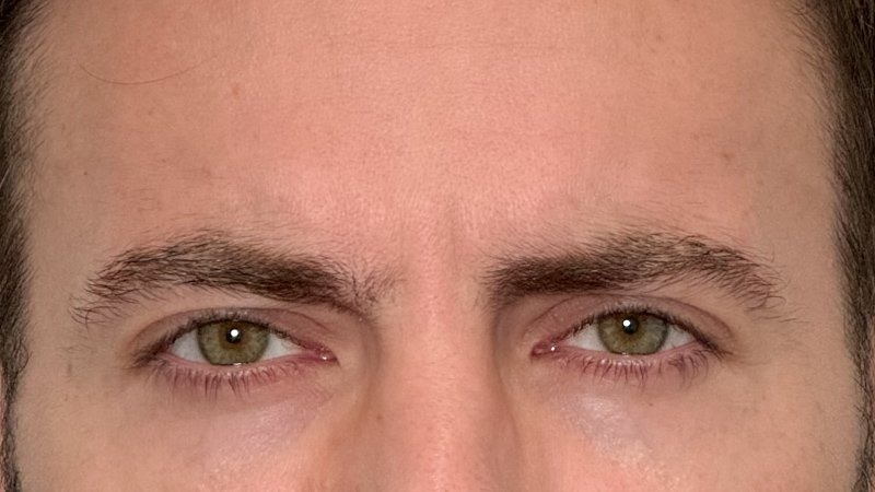 frown lines and wrinkles 11s botox west seattle before and after
