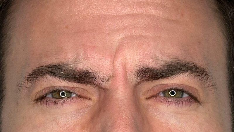 frown lines and wrinkles 11s botox west seattle before and after