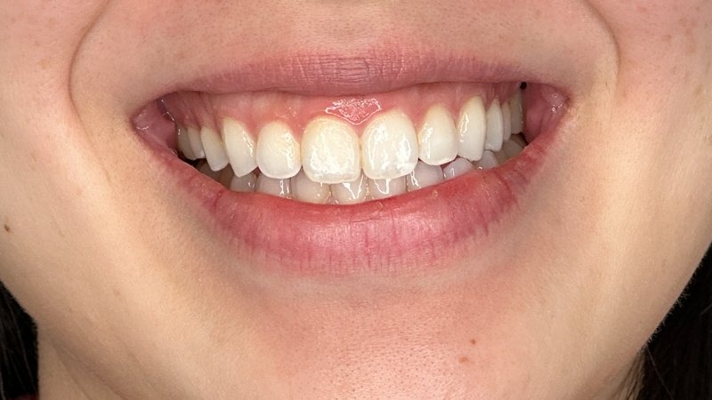gummy smile botox west seattle before and after