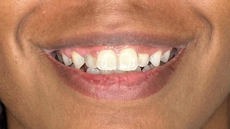 gummy smile botox west seattle before and after