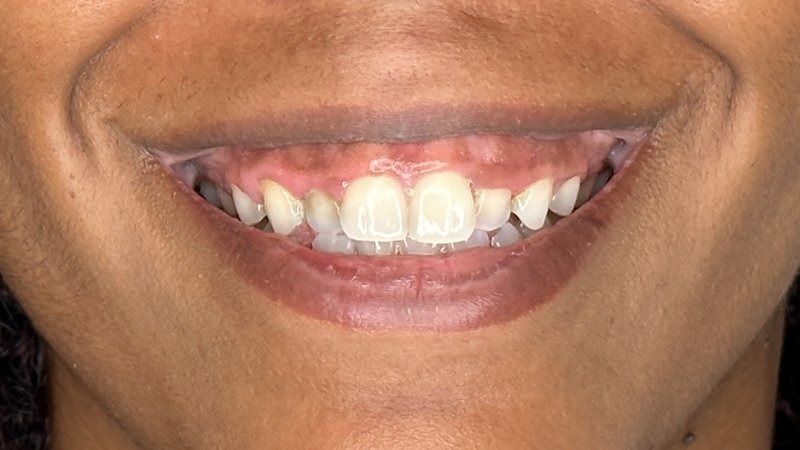 gummy smile botox west seattle before and after
