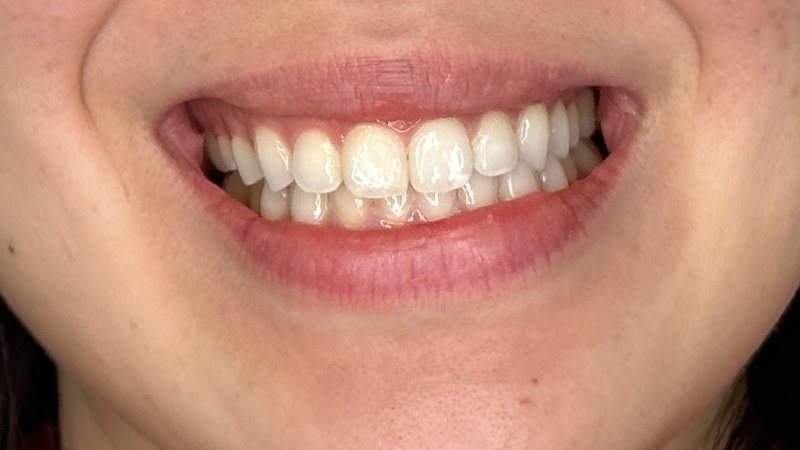 gummy smile botox west seattle before and after