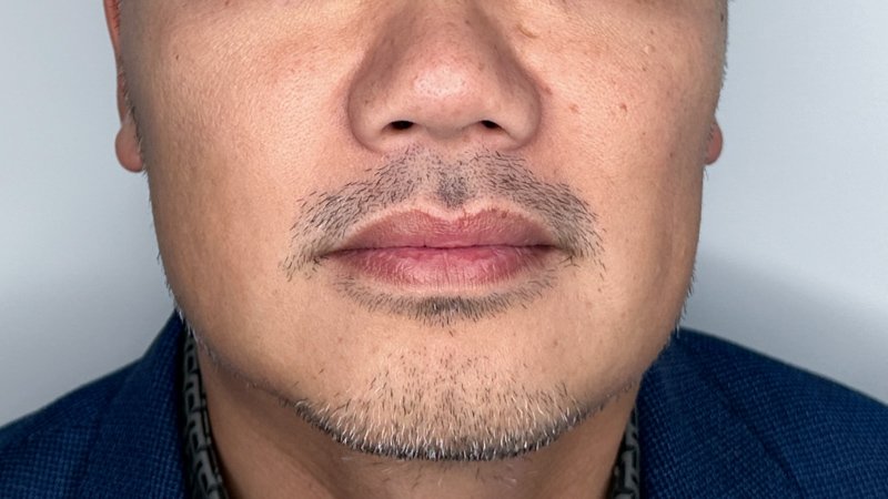 masseter botox west seattle before and after
