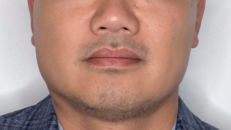 masseter botox west seattle before and after