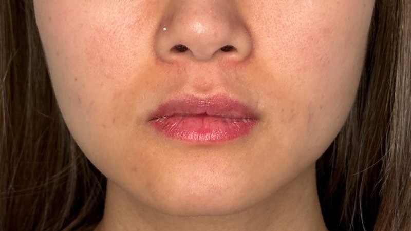 masseter botox west seattle before and after