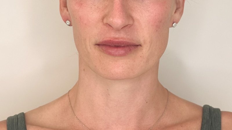 trap botox west seattle before and after
