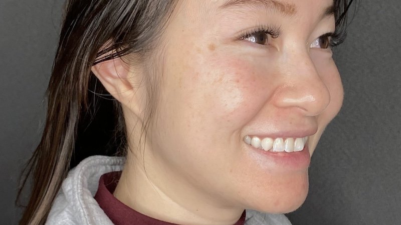 Sculptra - Cheeks and jaw - After -P1 copy2 sculptra botox collagen stimulator before and after west seattle