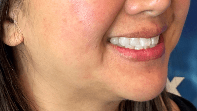 FILLER CHIN JEVEDERM FACIAL FILLER. FOREVER YOUNG AESTHETICS WEST SEATTLE