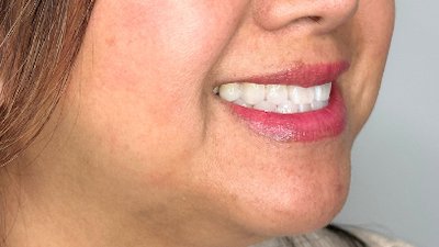 FILLER CHIN JEVEDERM FACIAL FILLER. FOREVER YOUNG AESTHETICS WEST SEATTLE