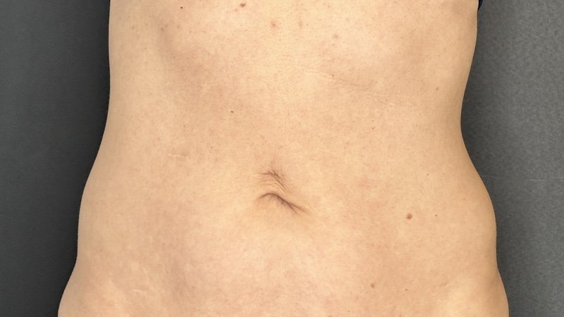 Kybella - BELLY and LOVE HANDLES - After copy KYBELLA ABDOMEN FAT REMOVAL SEATTLE WASHINGTON BEFORE AND AFTER