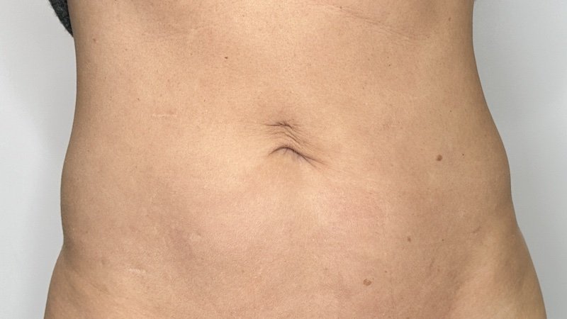 Kybella - BELLY and LOVE HANDLES - Before copy KYBELLA ABDOMEN FAT REMOVAL SEATTLE WASHINGTON BEFORE AND AFTER