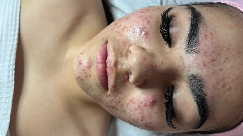 microneedling skinpen for acne