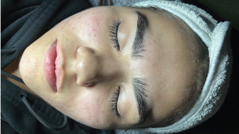 microneedling skinpen for acne after results