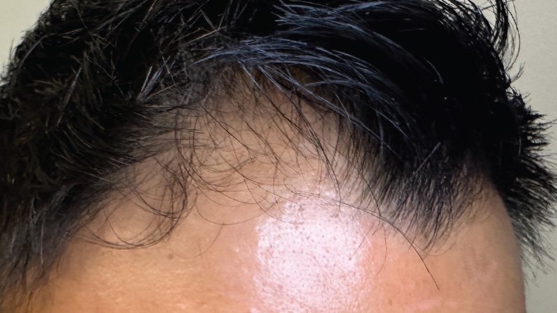 php restoration at forever young aesthetics west seattle