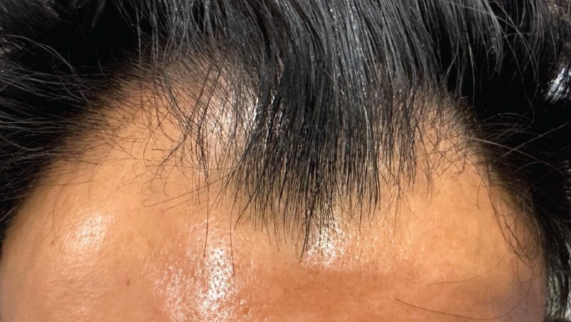 php restoration at forever young aesthetics west seattle