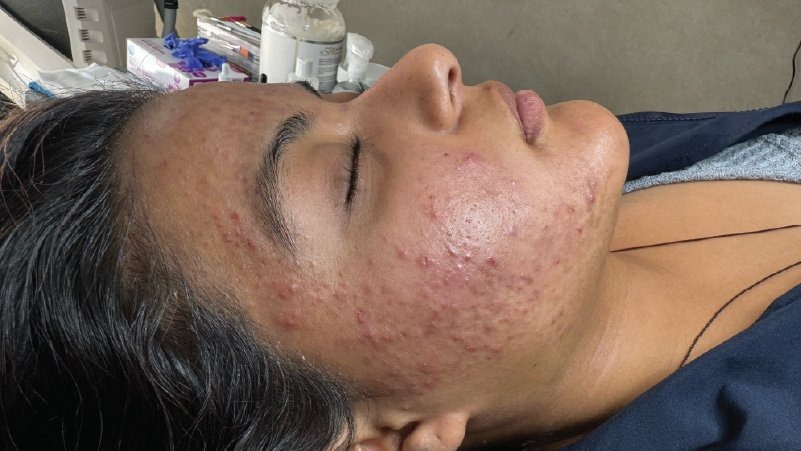 microneedling skinpen for acne at forever young aesthetics west seattle
