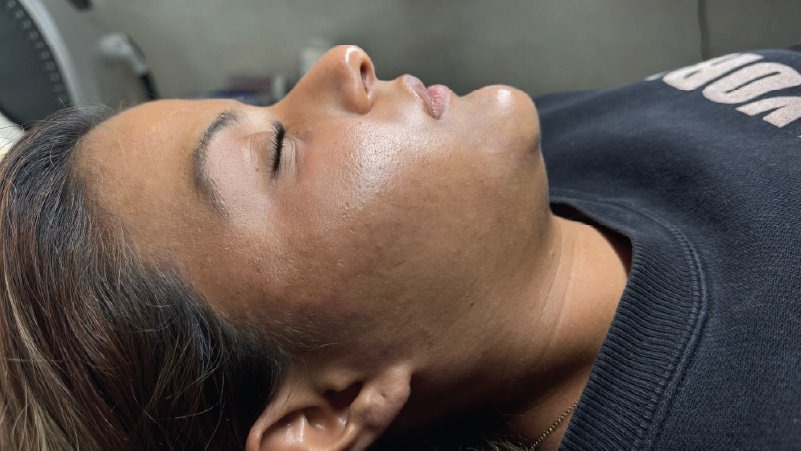 microneedling skinpen for acne after results