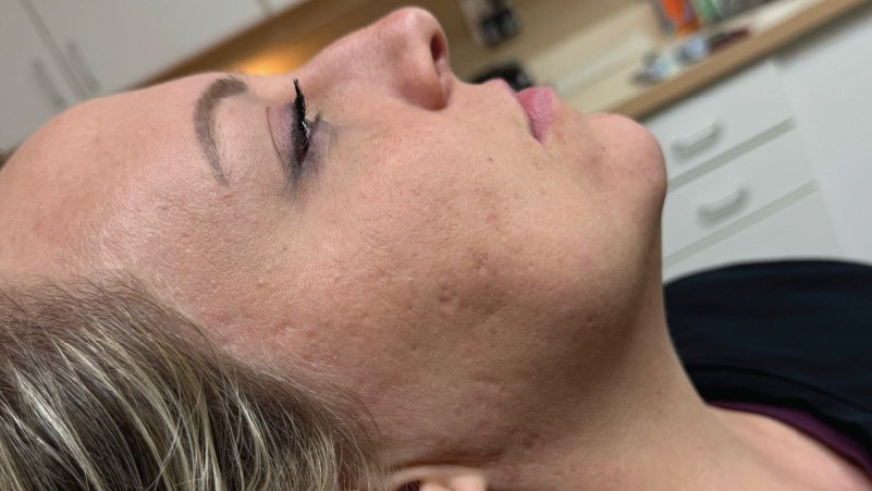 microneedling skinpen for acne after results