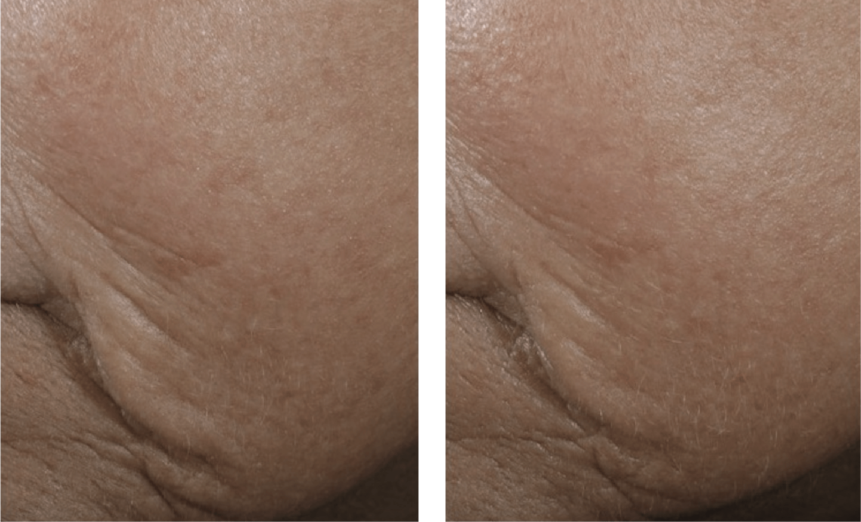 skin better facial products for anti-aging before and after. Only at Forever Young Aesthetics in West Seattle