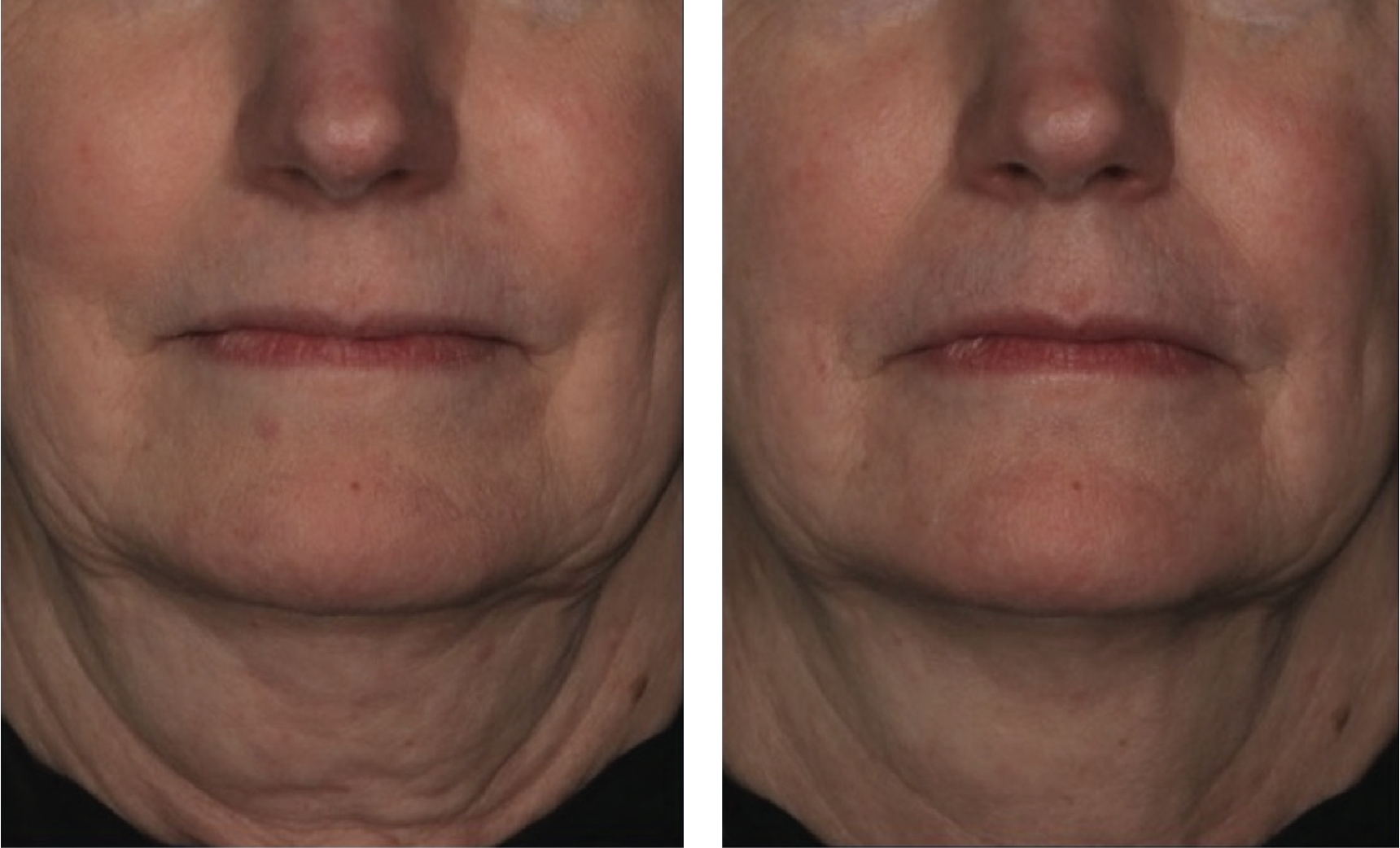 skin better facial products for anti-aging before and after. Only at Forever Young Aesthetics in West Seattle