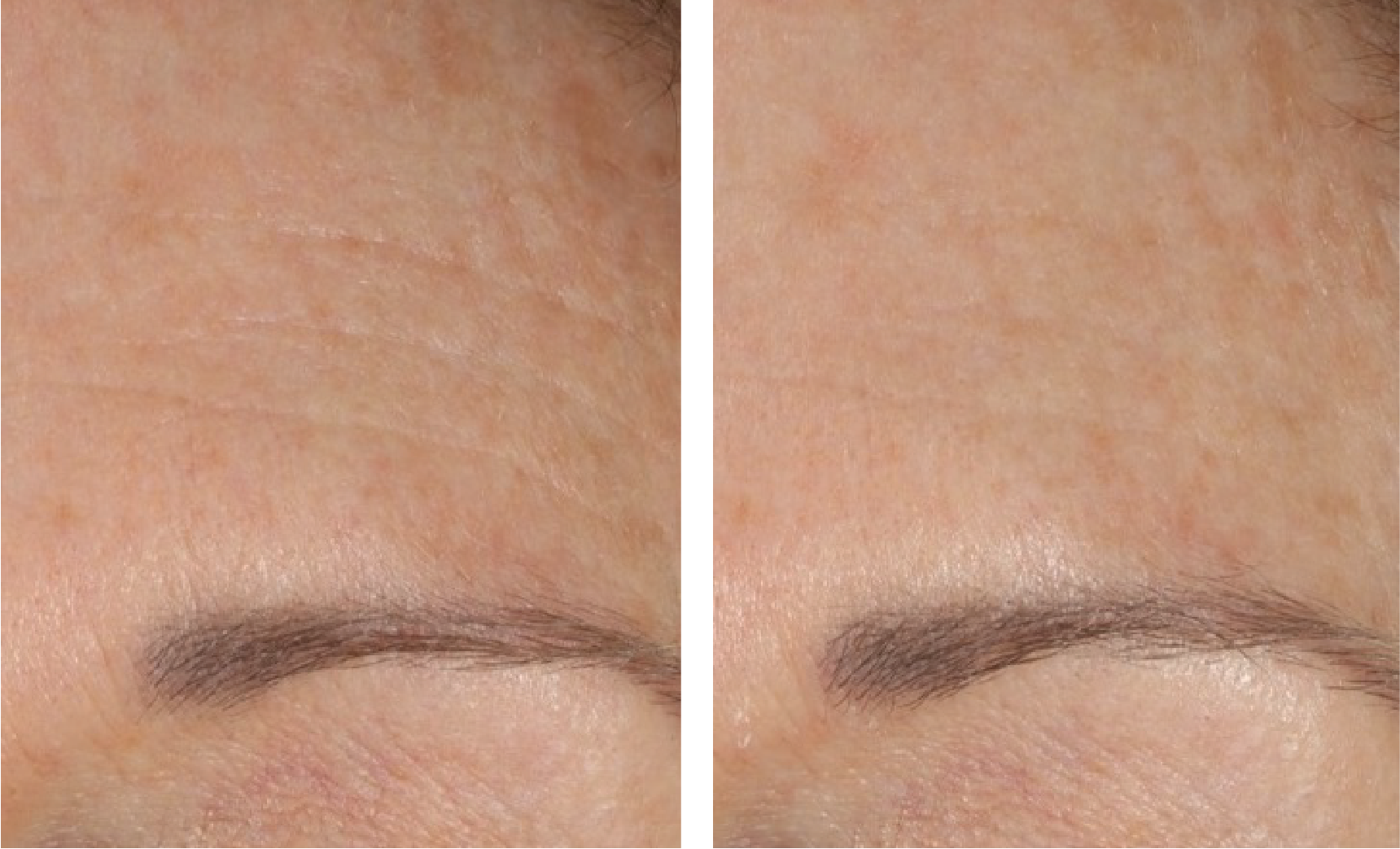 skin better facial products for anti-aging before and after. Only at Forever Young Aesthetics in West Seattle