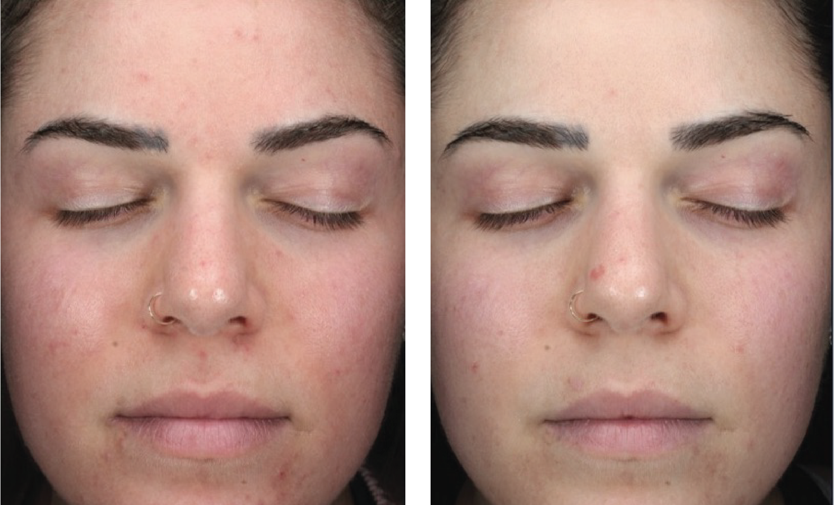 skin better facial products for anti-aging before and after. Only at Forever Young Aesthetics in West Seattle