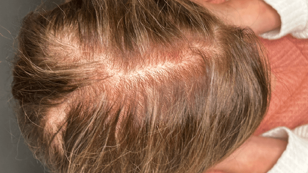 HAIR RESTORATION WITH PRP. West Seattle hair restoration