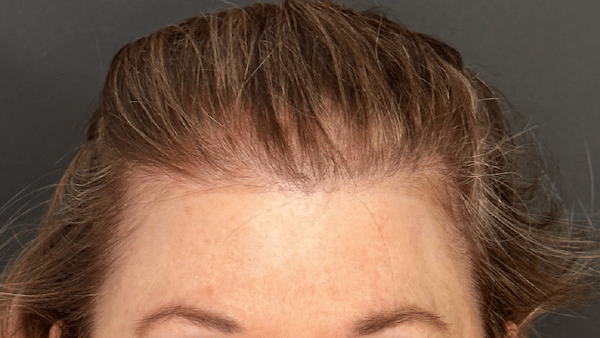 HAIR RESTORATION WITH PRP. West Seattle hair restoration
