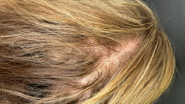 HAIR RESTORATION WITH PRP. West Seattle hair restoration