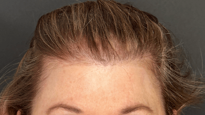 HAIR RESTORATION WITH PRP. West Seattle hair restoration