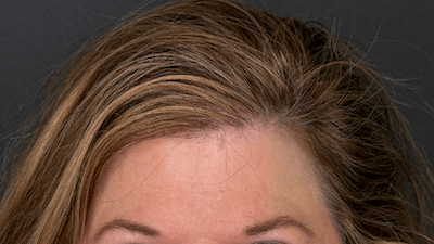HAIR RESTORATION WITH PRP. West Seattle hair restoration