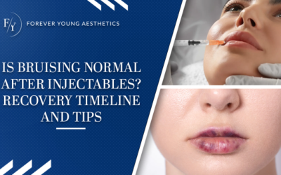 Is Bruising Normal After Injectables? Recovery Timeline and Tips