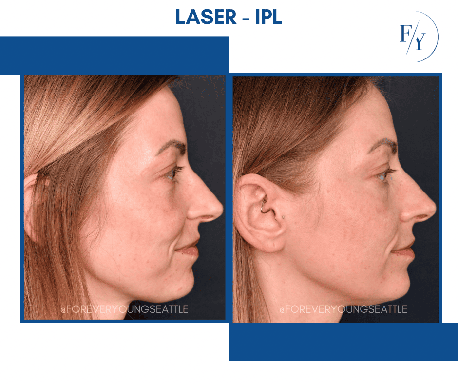 skin better facial products for anti-aging before and after. Only at Forever Young Aesthetics in West Seattle