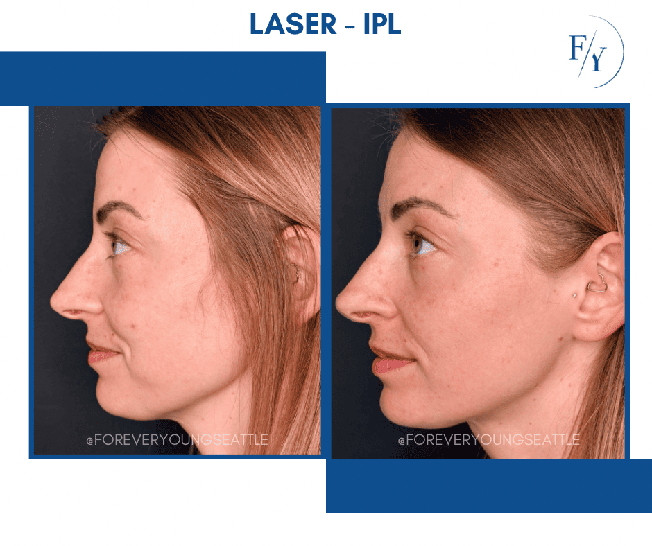 chin and jowel derma filler juviderm injections west seattle before and after