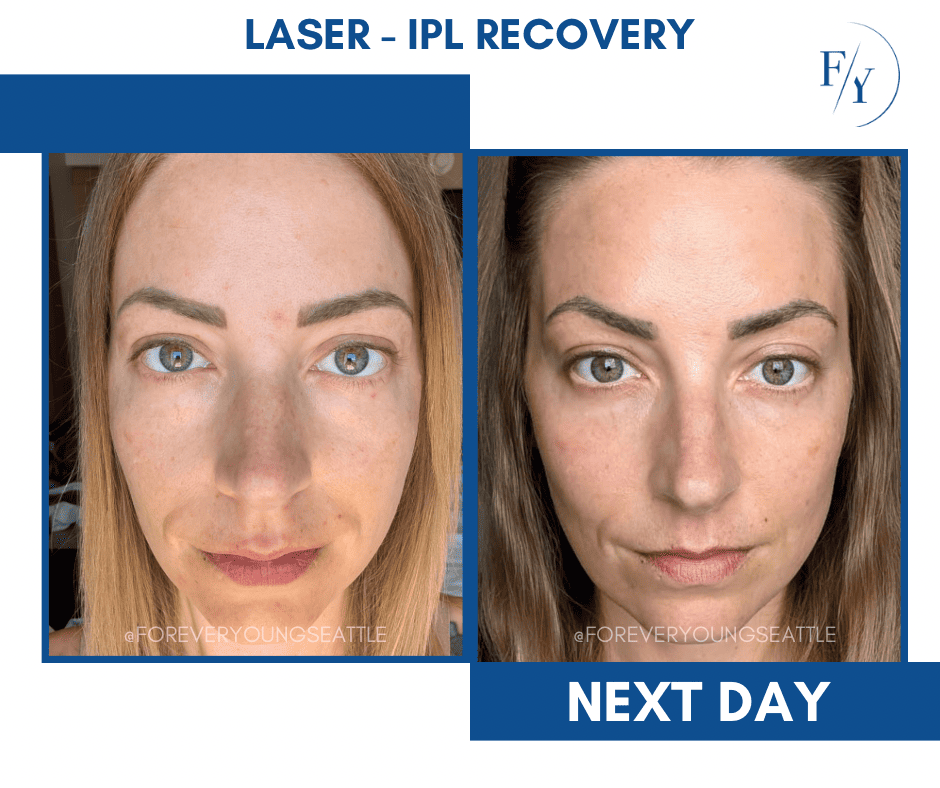 skin better facial products for anti-aging before and after. Only at Forever Young Aesthetics in West Seattle