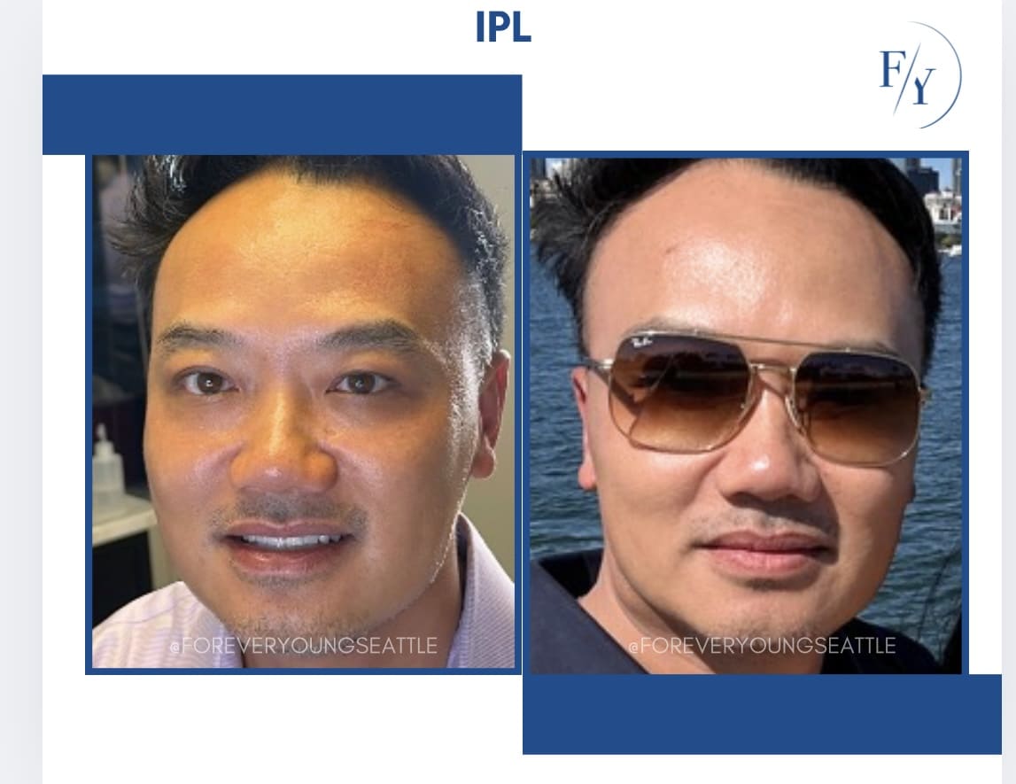 skin better facial products for anti-aging before and after. Only at Forever Young Aesthetics in West Seattle